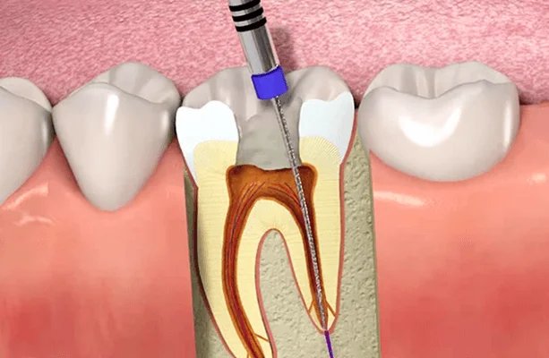 Root Canal Treatment Ahmedabad
