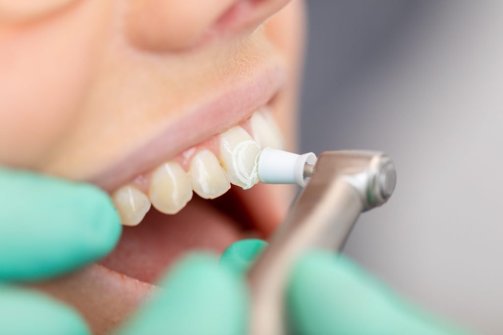 Teeth Cleaning & Whitening Ahmedabad